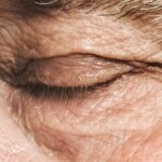 Clinical image illustrating Eyelid Twitching