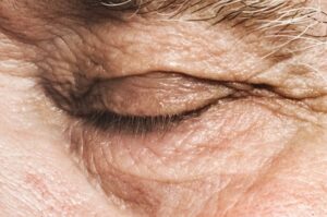 Clinical image illustrating Eyelid Twitching