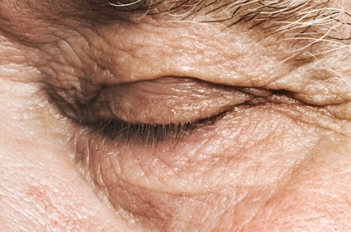 Clinical image illustrating Eyelid Twitching