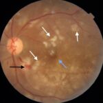 Clinical eye photograph illustrating Fat Embolism Retinopathy Long Bone Fracture