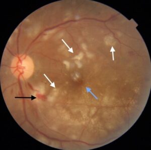 Clinical eye photograph illustrating Fat Embolism Retinopathy Long Bone Fracture