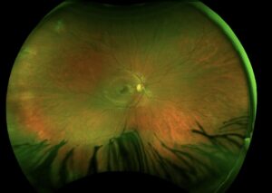 Clinical eye photograph illustrating Fellow Eye Retinal Detachment Risk