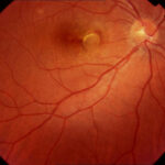 Clinical eye photograph illustrating Fibrovascular Ped