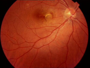 Clinical eye photograph illustrating Fibrovascular Ped