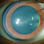 Clinical eye photograph illustrating Fleischer Ring Keratoconus Iron Line