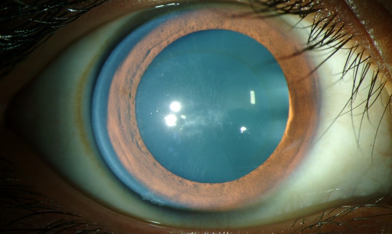 Clinical eye photograph illustrating Fleischer Ring Keratoconus Iron Line