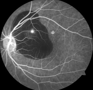 Clinical image illustrating Fluorescein Angiography Patterns