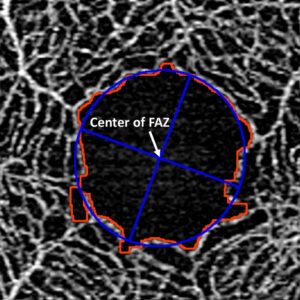 Clinical image illustrating Foveal Avascular Zone