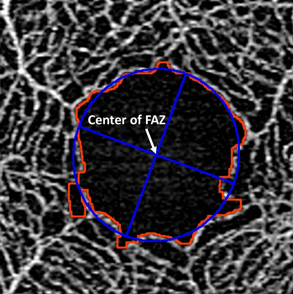 Clinical image illustrating Foveal Avascular Zone