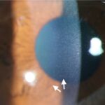 Clinical eye photograph illustrating Frostbite Eye