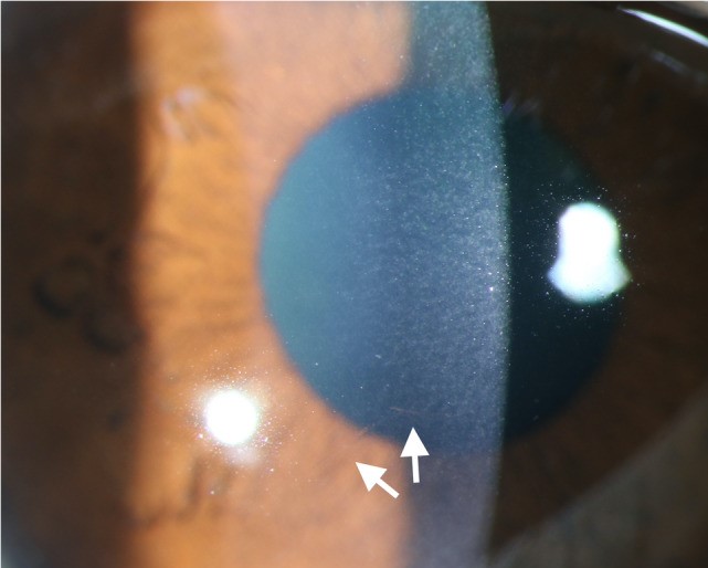 Frostbite of the Eye and Periocular Tissue: An Uncommon but Genuine Cold-Weather Threat