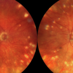 Clinical eye photograph illustrating Fuchs Spot Forster Fuchs Myopia