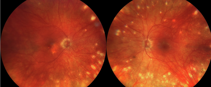 Fuchs Spot: The Dark, Raised Pigment Patch at the Fovea of the Highly Myopic Eye