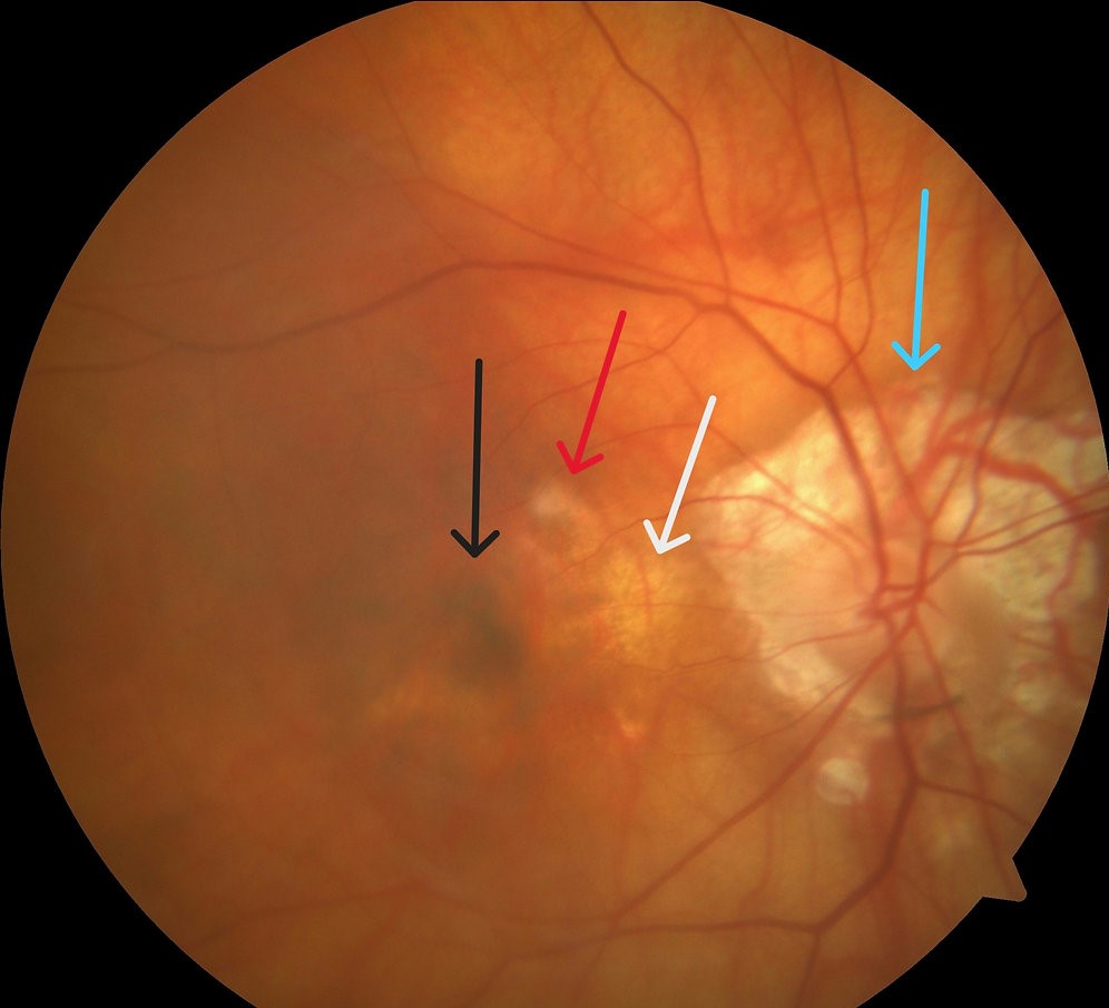 Clinical eye photograph illustrating Fuchs Spot Forster Fuchs Myopia