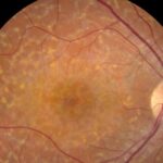 Clinical eye photograph illustrating Fundus Flavimaculatus Stargardt Differential
