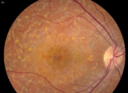 Fundus Flavimaculatus and Stargardt Disease: One Spectrum, Two Names