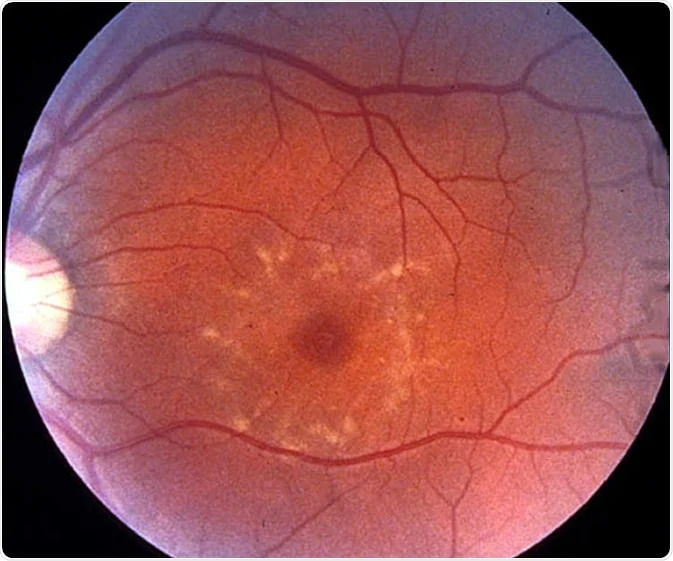 Clinical eye photograph illustrating Fundus Flavimaculatus Stargardt Differential