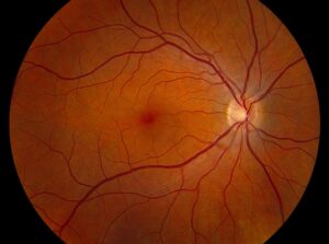 Clinical eye photograph illustrating Fundus Photography Technique Artifacts