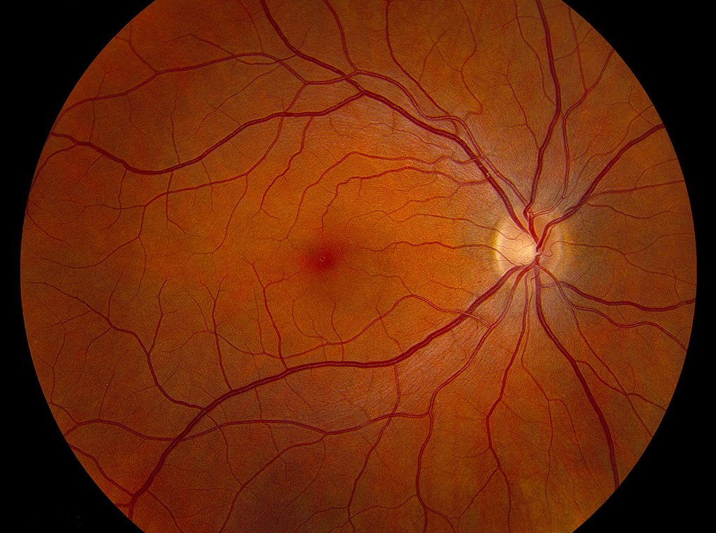 Clinical eye photograph illustrating Fundus Photography Technique Artifacts