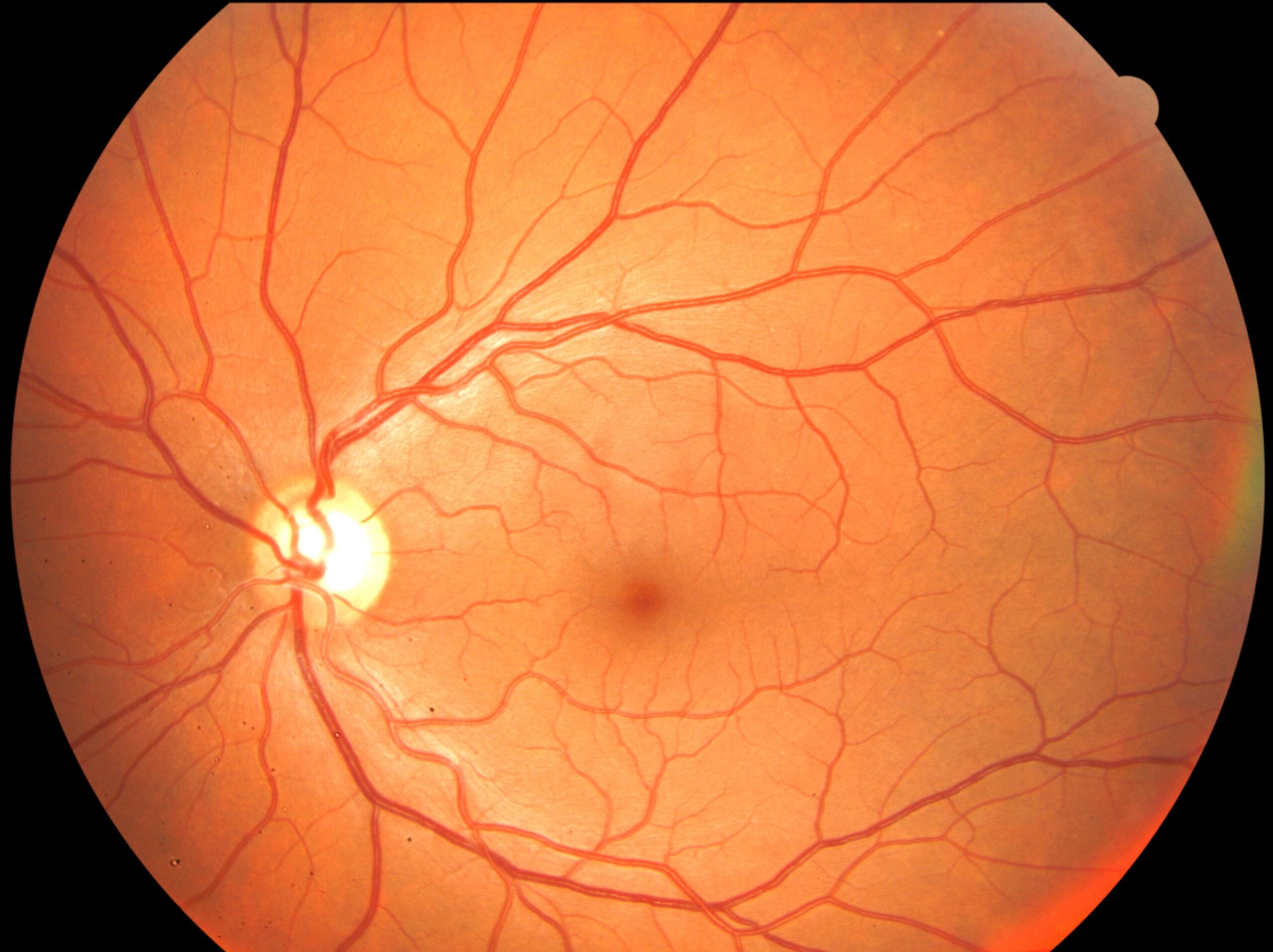 Clinical eye photograph illustrating Fundus Photography Technique Artifacts