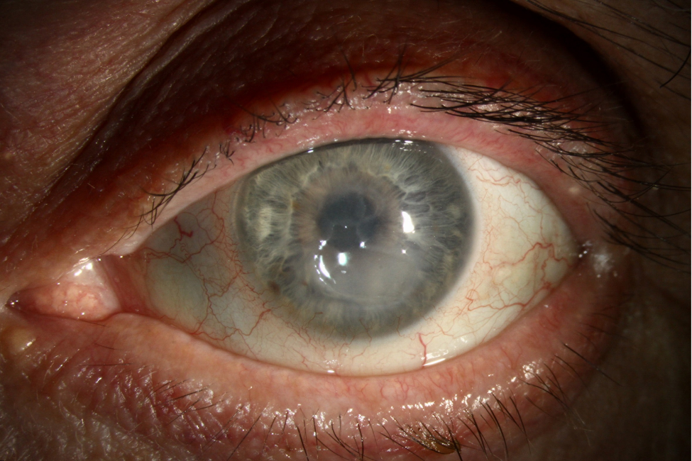 Clinical image illustrating Fungal Keratitis