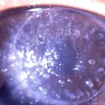 Clinical eye photograph illustrating Gelatinous Drop Like Corneal Dystrophy