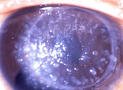 Gelatinous Drop-Like Corneal Dystrophy: An Amyloid Disease That Mimics Something Far More Common