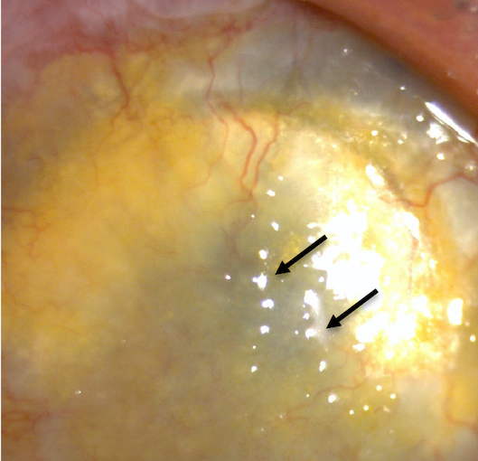 Clinical eye photograph illustrating Gelatinous Drop Like Corneal Dystrophy