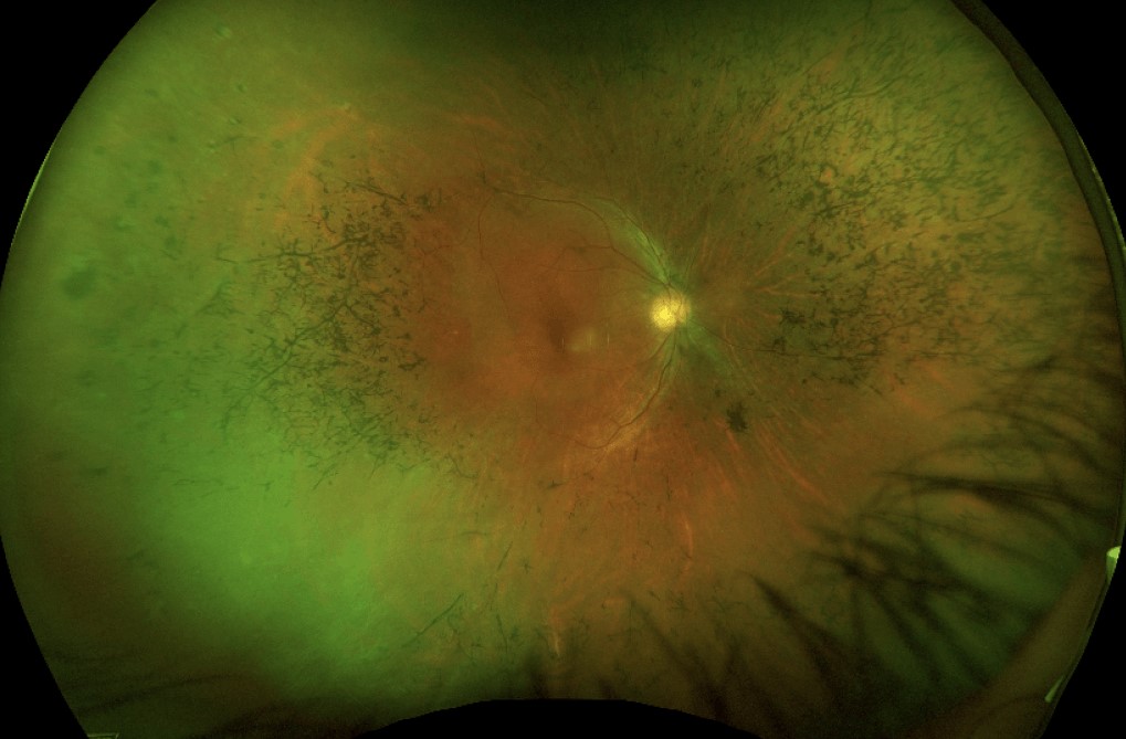 Clinical image illustrating Genetic Testing for Inherited Retinal Disease