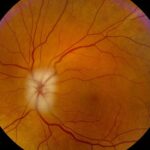 Clinical eye photograph illustrating Giant Cell Arteritis Ocular Presentation Workup