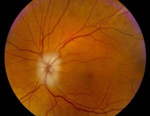 Clinical eye photograph illustrating Giant Cell Arteritis Ocular Presentation Workup