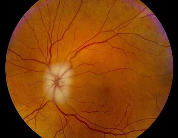 Clinical eye photograph illustrating Giant Cell Arteritis Ocular Presentation Workup