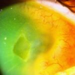 Clinical eye photograph illustrating Giant Fornix Syndrome