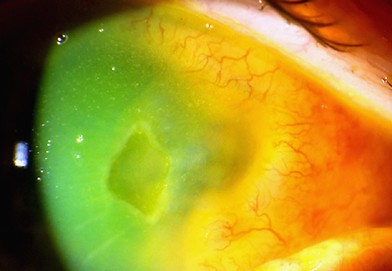 Clinical eye photograph illustrating Giant Fornix Syndrome