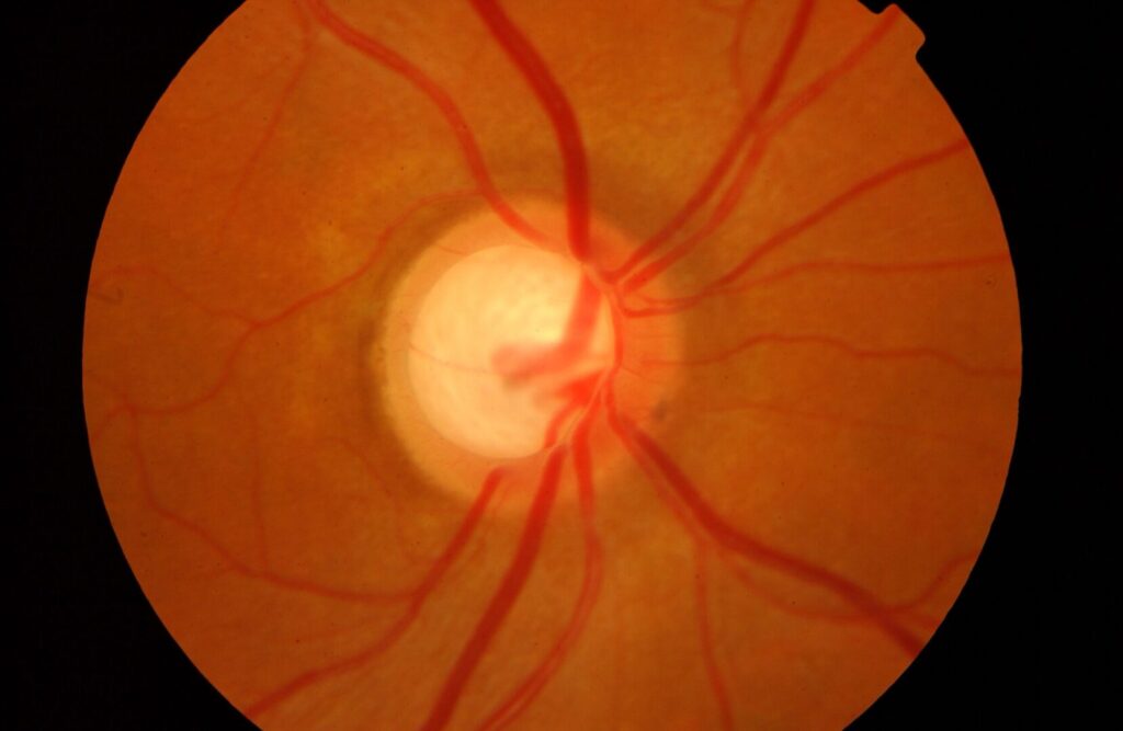 Clinical image illustrating Glaucoma Eye Drops