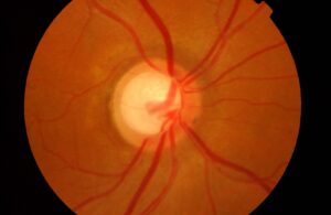 Clinical image illustrating Glaucoma Eye Drops