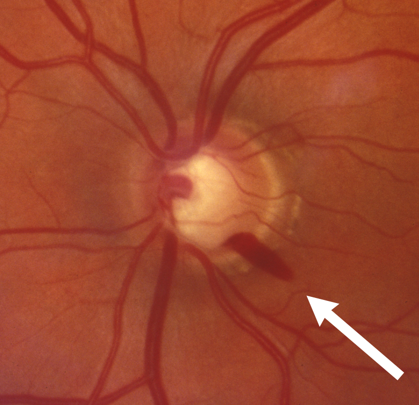 Clinical image illustrating Glaucoma Progression (figure 1)