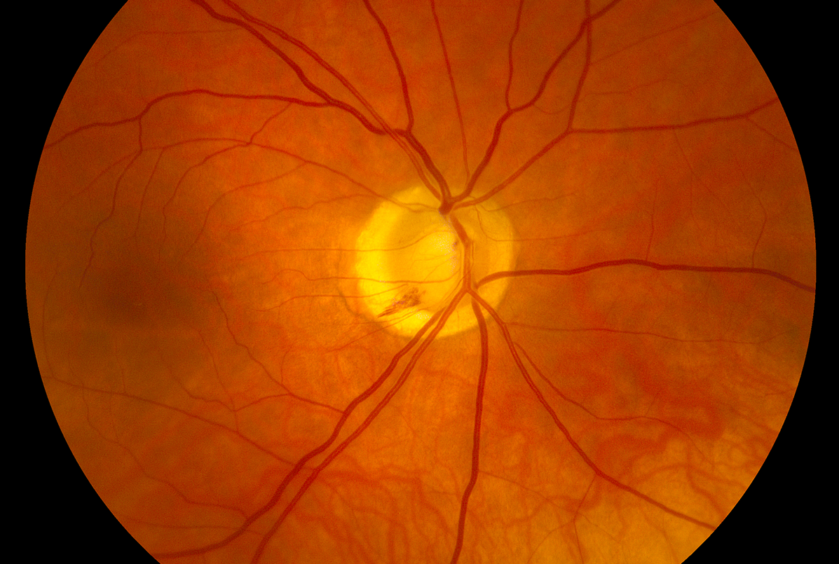 Clinical image illustrating Glaucoma Progression (figure 2)