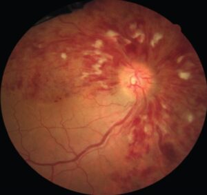 Clinical eye photograph illustrating Glaucoma Retinal Vein Occlusion Association Risk