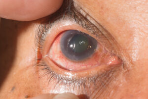 Clinical image illustrating Glaucoma Risk Factors