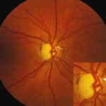 Clinical image illustrating Glaucoma Screening (figure 1)