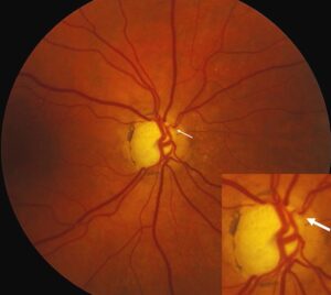 Clinical image illustrating Glaucoma Screening (figure 1)