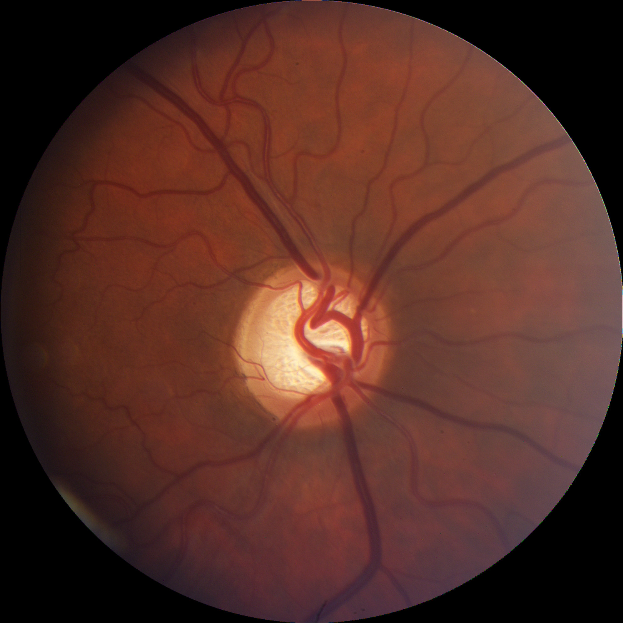 Clinical image illustrating Glaucoma Screening (figure 2)