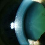 Clinical eye photograph illustrating Glaukomflecken Acute Angle Closure