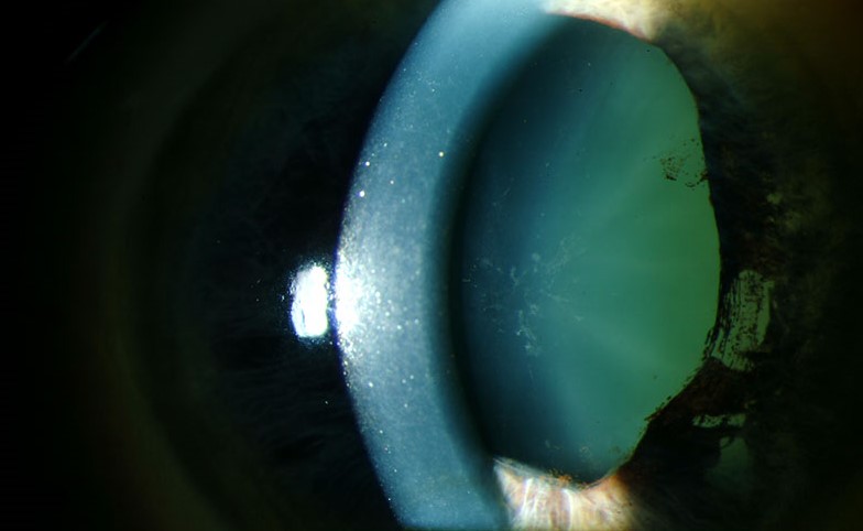 Glaukomflecken: The Small Subcapsular Lens Opacities That Mark a Past Attack of Acute Angle Closure