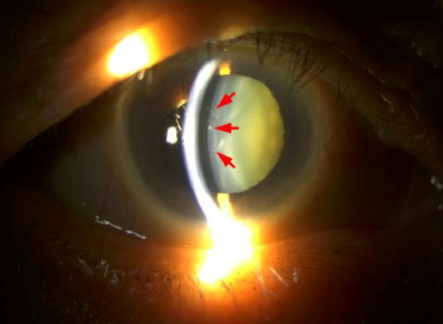 Clinical eye photograph illustrating Glaukomflecken Acute Angle Closure