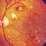 Clinical image illustrating Glycemic Control and Diabetic Retinopathy Progression (figure 1)