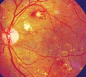 Clinical image illustrating Glycemic Control and Diabetic Retinopathy Progression (figure 1)