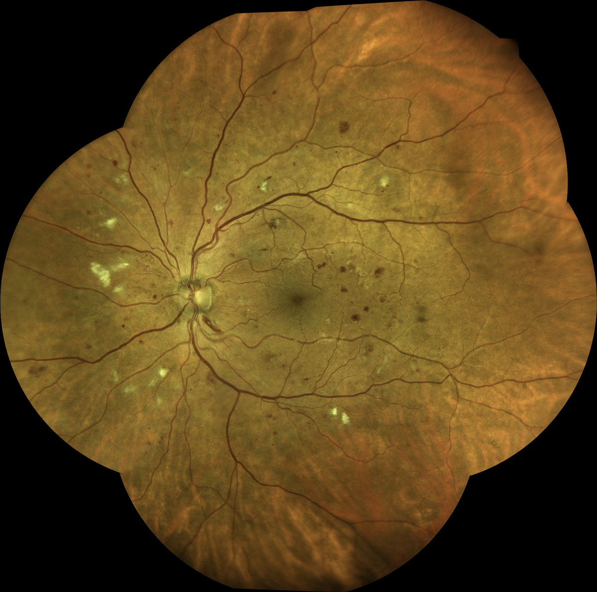 Clinical image illustrating Glycemic Control and Diabetic Retinopathy Progression (figure 2)