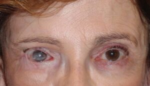 Clinical eye photograph illustrating Gold Weight Implant Facial Palsy